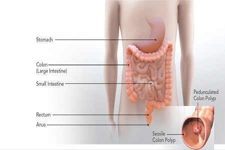 Scientific Diagram of Colon Cancer